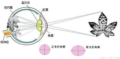 治疗散光的方法有哪些