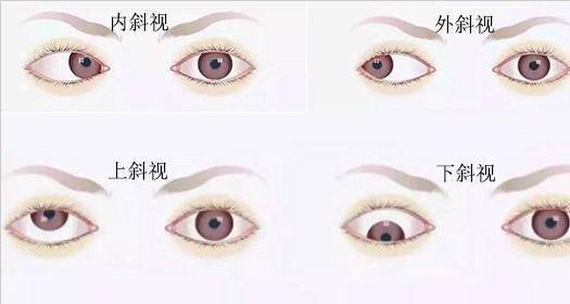 斜视怎么治